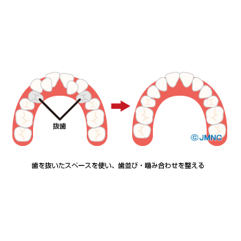 抜歯を伴う矯正歯科治療