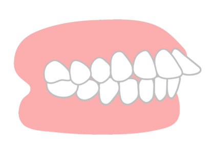 軽度の出っ歯の方