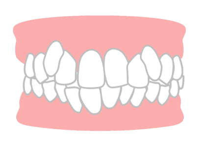 軽度の叢生の方
