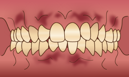 歯肉ピーリング