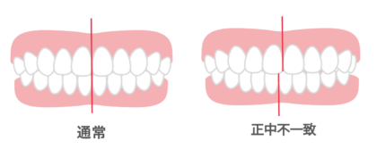 不正咬合・正中不一致